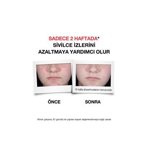 NEUTROGENA SİVİLCE KARŞITI PLUS SERUM 30 ML-