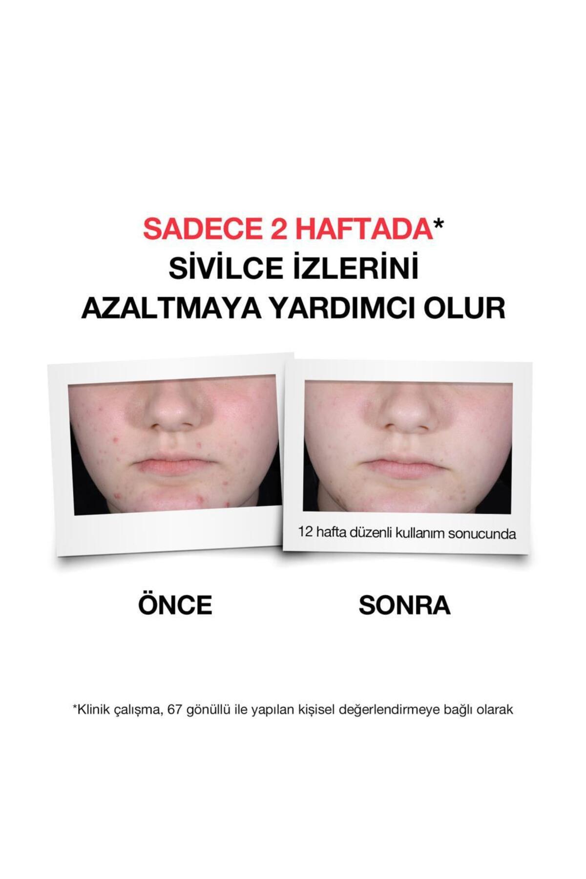NEUTROGENA SİVİLCE KARŞITI PLUS SERUM 30 ML-